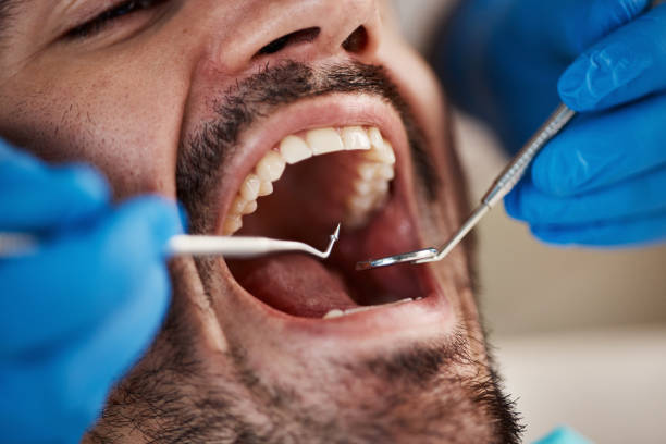 Best Emergency Root Canal Treatment in Experiment, GA