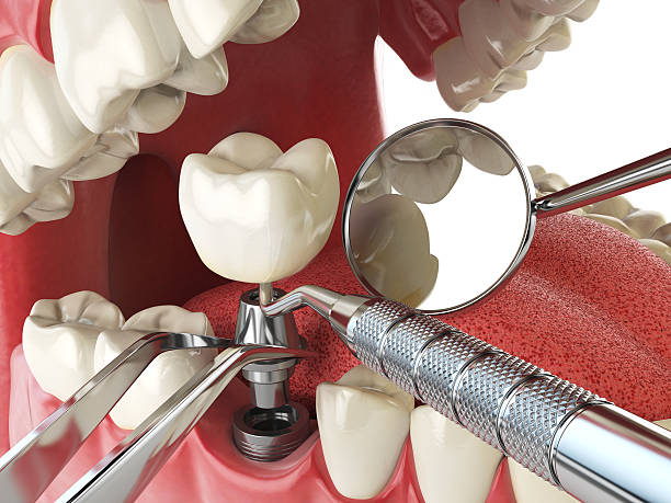 Best Emergency Dental Care for Broken or Chipped Teeth in Experiment, GA